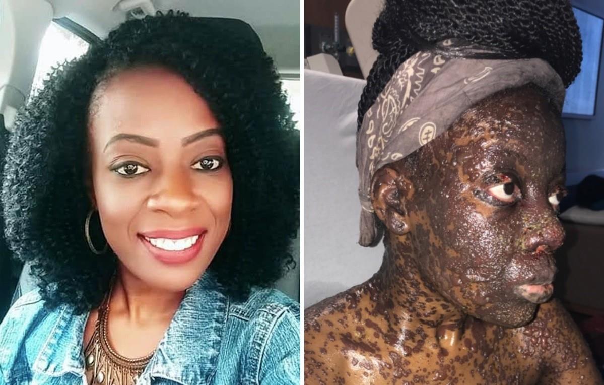 Mulher sofre reação ao usar remédio para ouvido