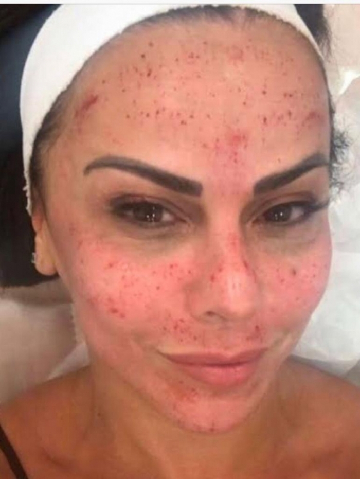 Instituto Sensk Premiará as Vencedoras da Revista Feras com Microagulhamento Facial